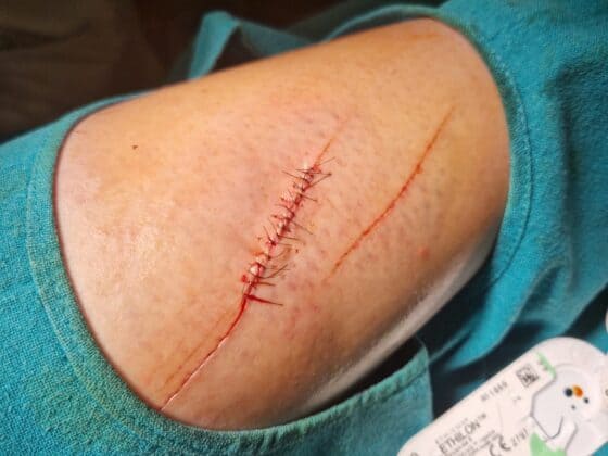 Zwangspause für Franziska Fries (NÖ)! Die 32-jährige Grand-Prix-Reiterin muss nach einem Schnorchel-Unfall pausieren. © Privat