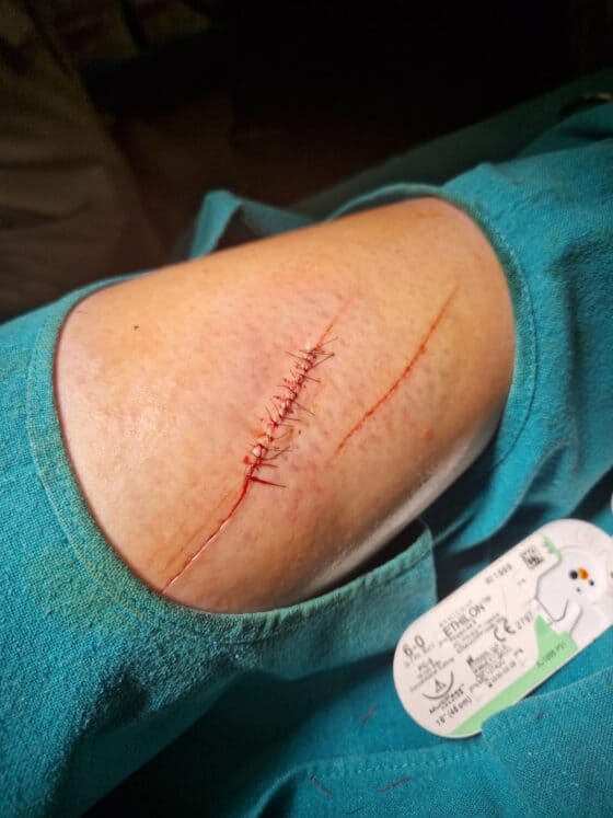 Zwangspause für Franziska Fries (NÖ)! Die 32-jährige Grand-Prix-Reiterin muss nach einem Schnorchel-Unfall pausieren. © Privat